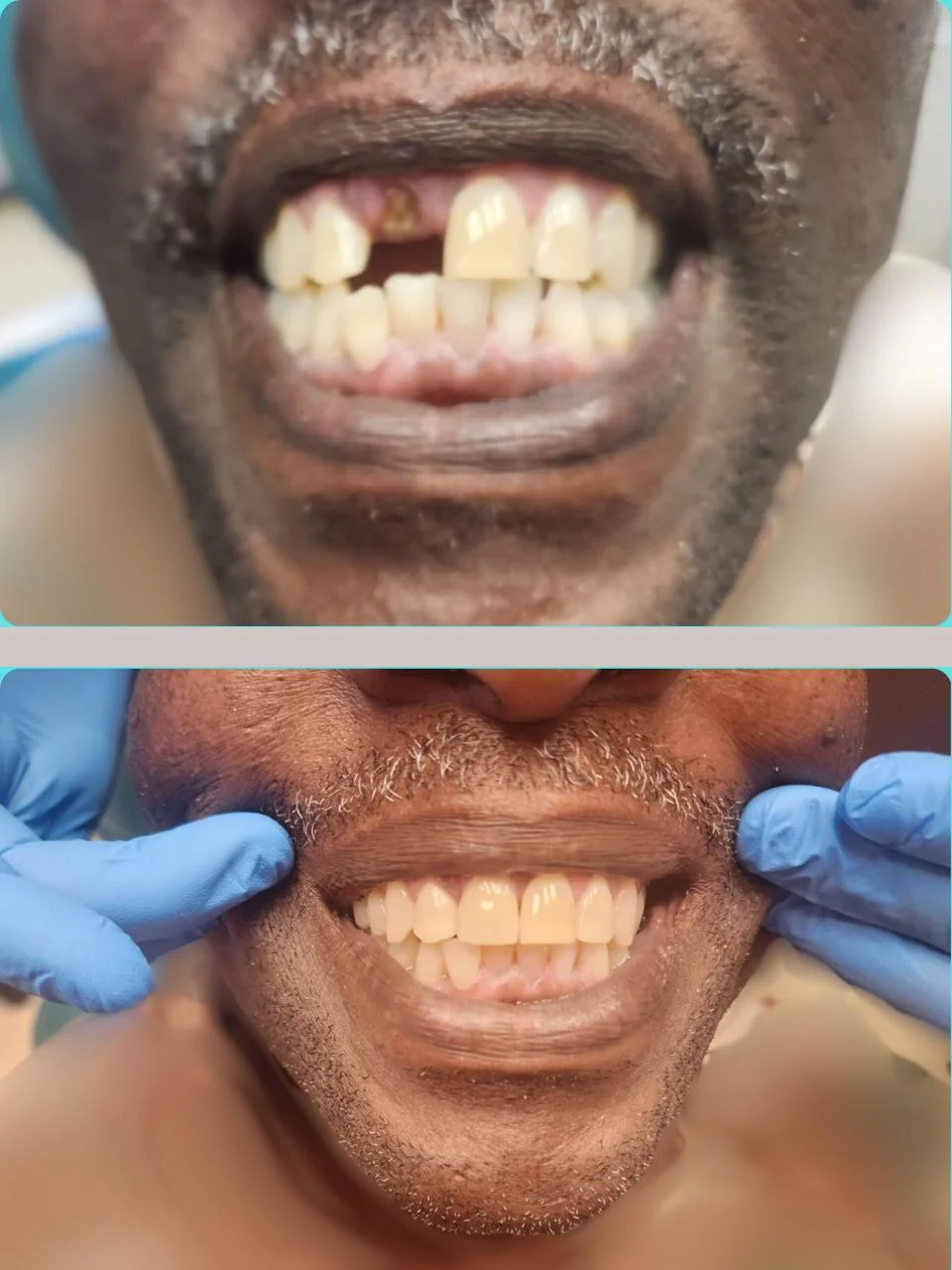 Before and after: missing tooth repair